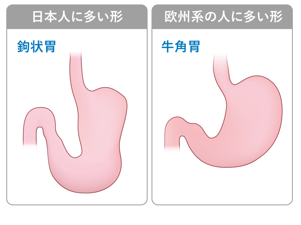 【図】日本人と欧州系の人の胃の形の違い