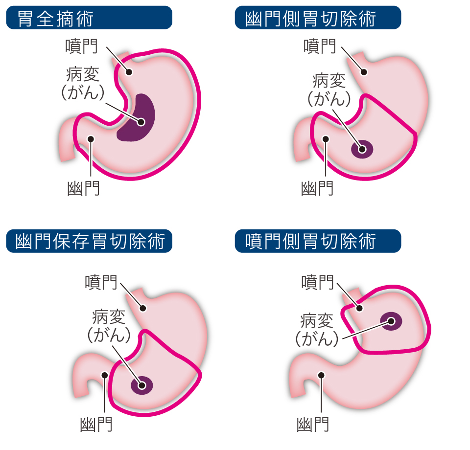 【図】胃がん手術の方法