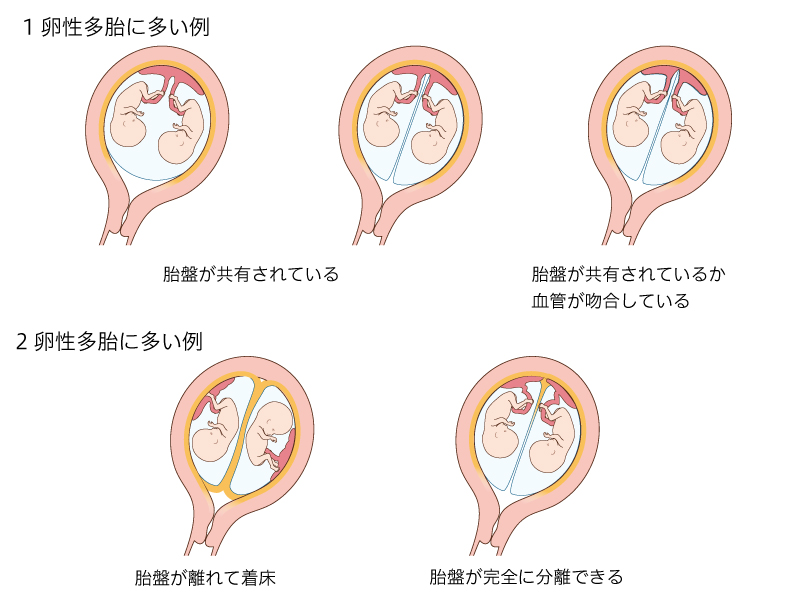 【図】多胎のタイプ